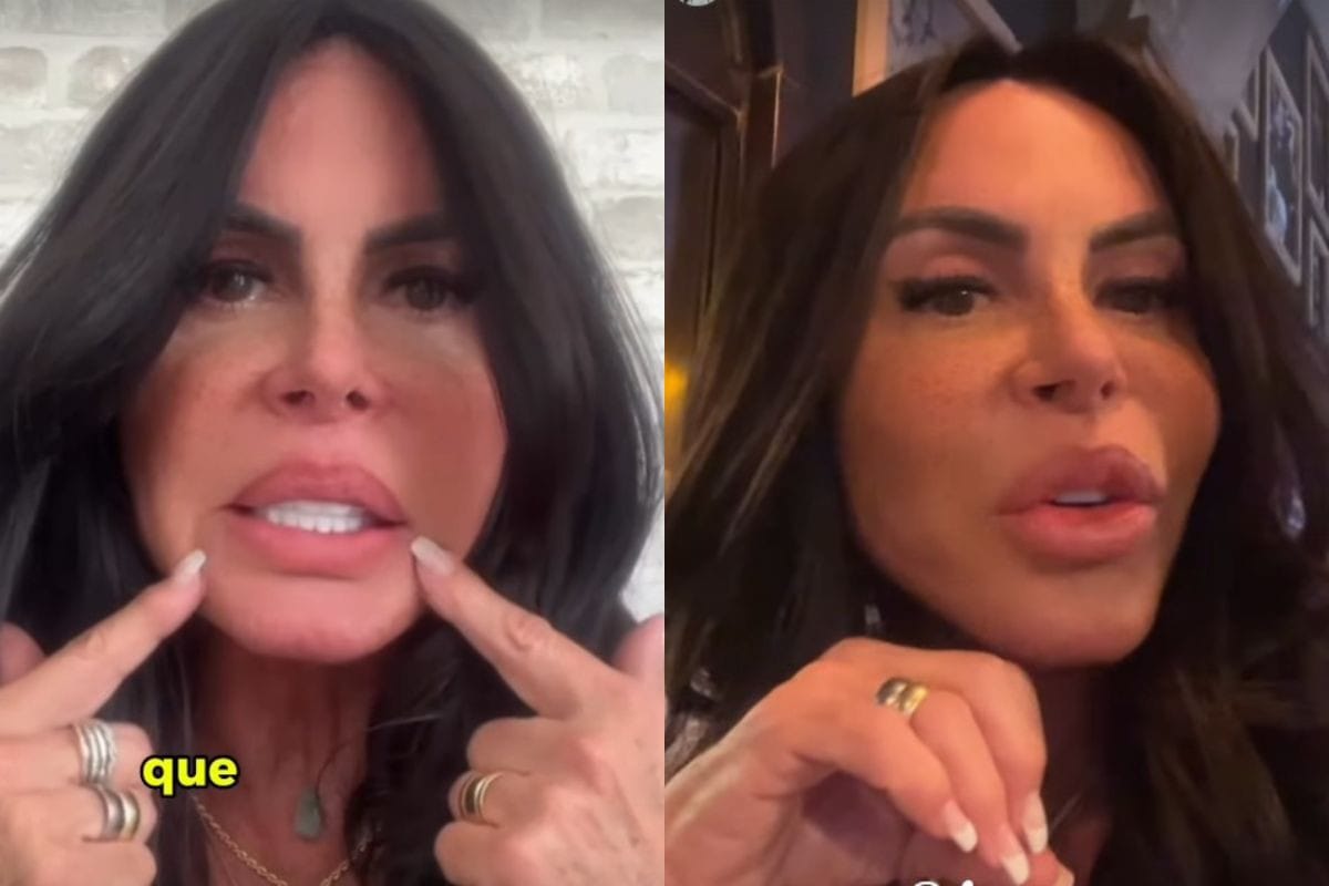 PMMA nos Lábios: Gretchen Revela Por que Removeu o Preenchimento Permanente