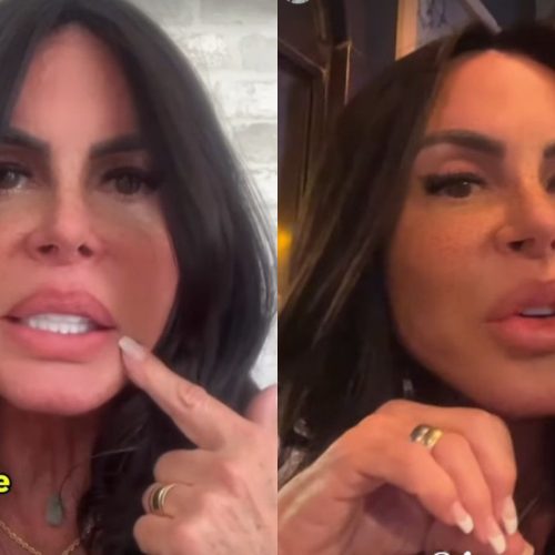 PMMA nos Lábios: Gretchen Revela Por que Removeu o Preenchimento Permanente