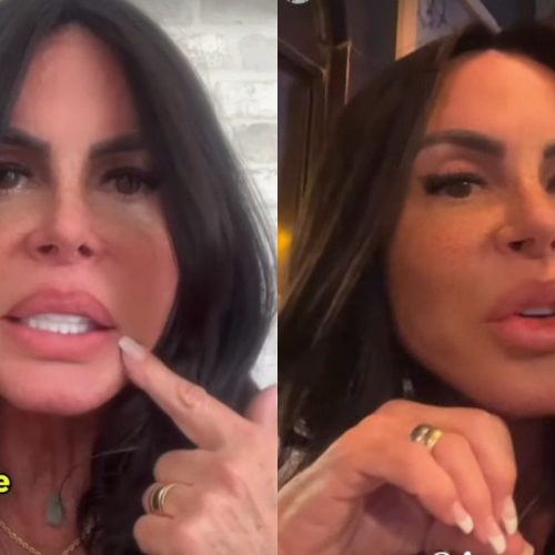 PMMA nos Lábios: Gretchen Revela Por que Removeu o Preenchimento Permanente